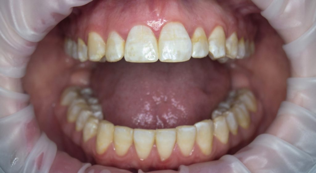caso di fluorosi dentale