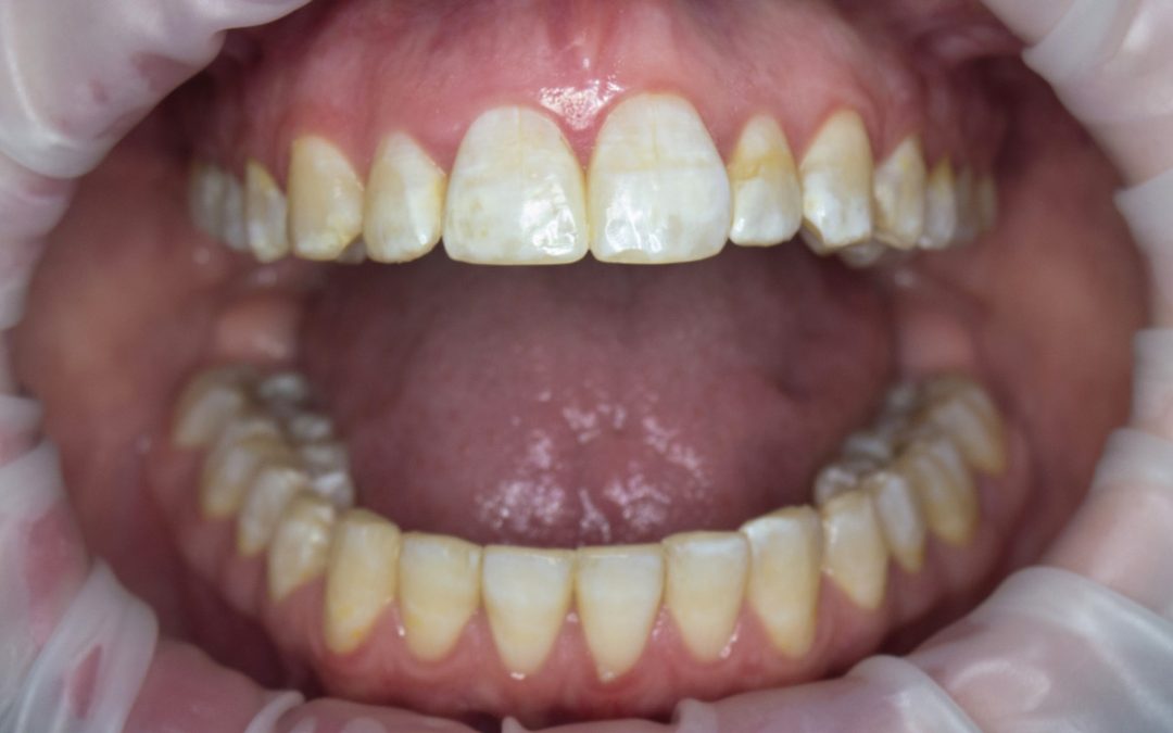 caso-fluorosi