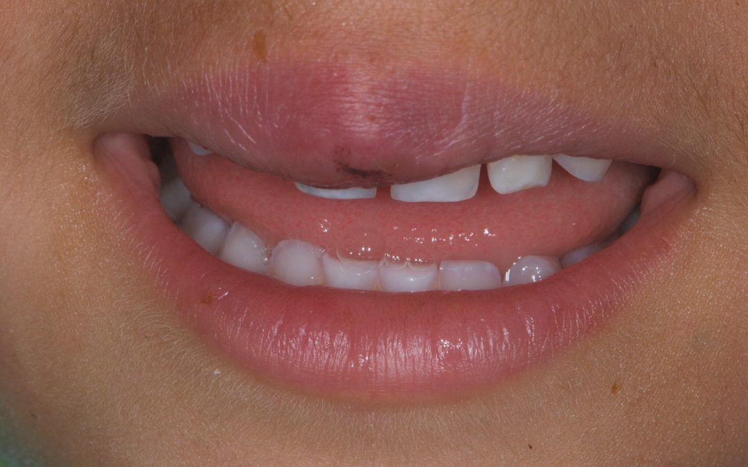 Traumi denti da latte bambini