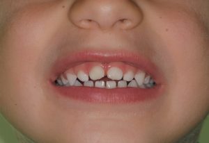 Traumi denti decidui bambini