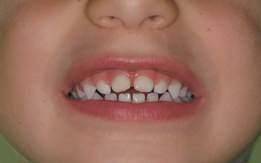 Trauma dente da latte